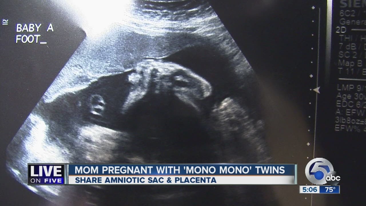 Orrville mom delivers rare set of mono mono identical twin girls