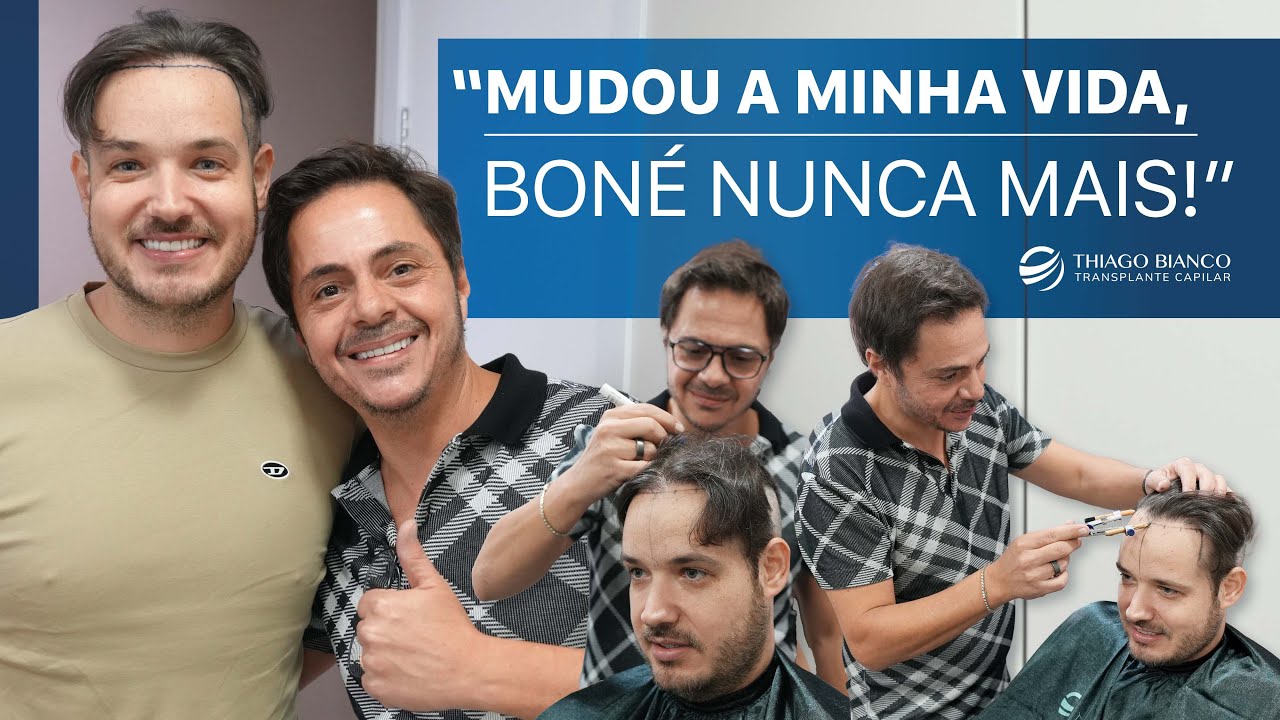 Transplante Capilar do Israel Ribeiro  - “Abandonei de vez o boné!” | Dr. Thiago Bianco