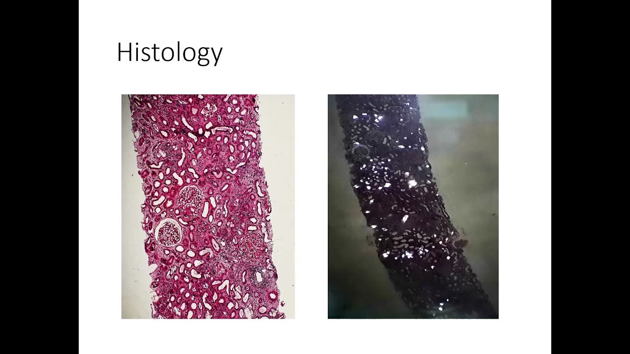 John Otieno,  Oxalate Nephropathy