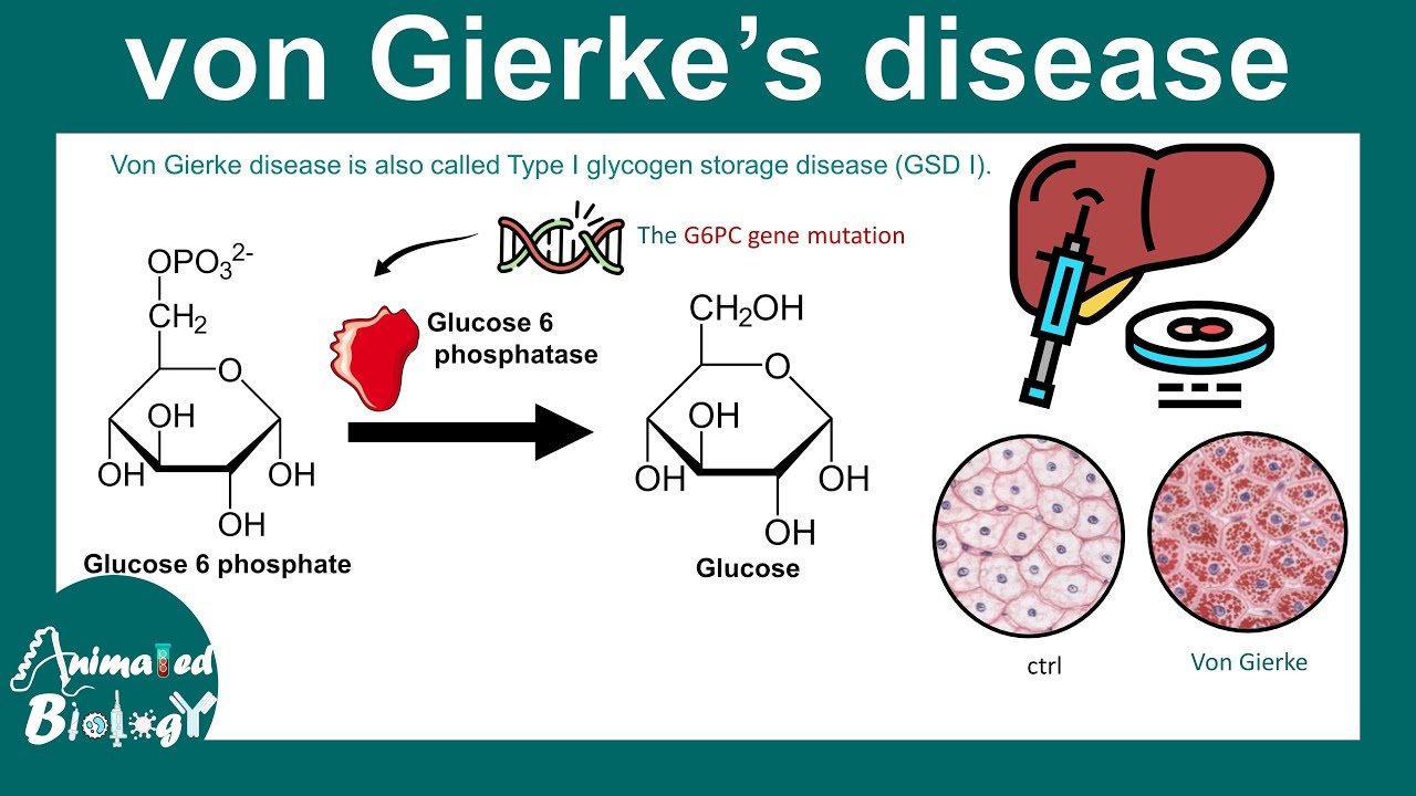 Von Gierke disease | Type I glycogen storage disease (GSD I) | Glycogen metabolism