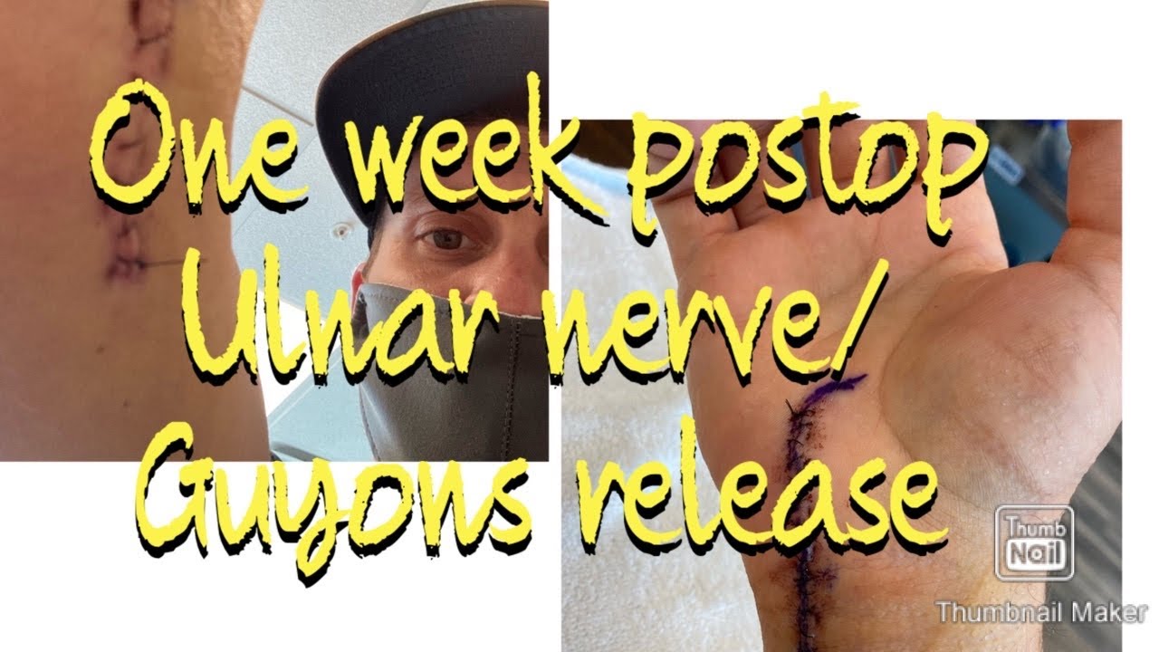 Eight Days postop ulnar nerve and Guyon’s Canal release