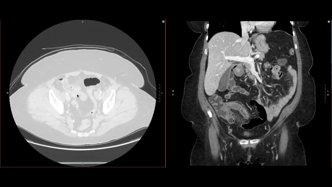 Abdominal Imaging Call Prep Cases: Perforated Appendicitis (CT) Case 1 Discussion