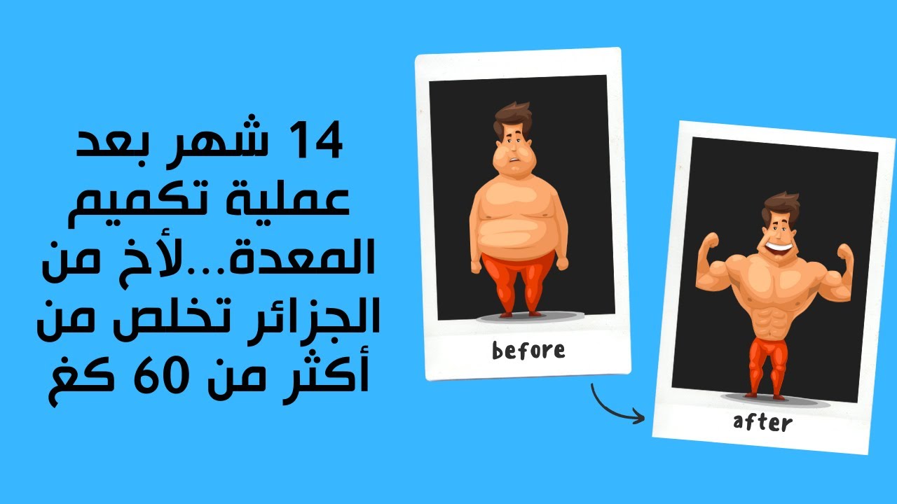 14 شهر بعد عملية تكميم المعدة...لأخ من الجزائر  تخلص من أكثر من 60 كغ