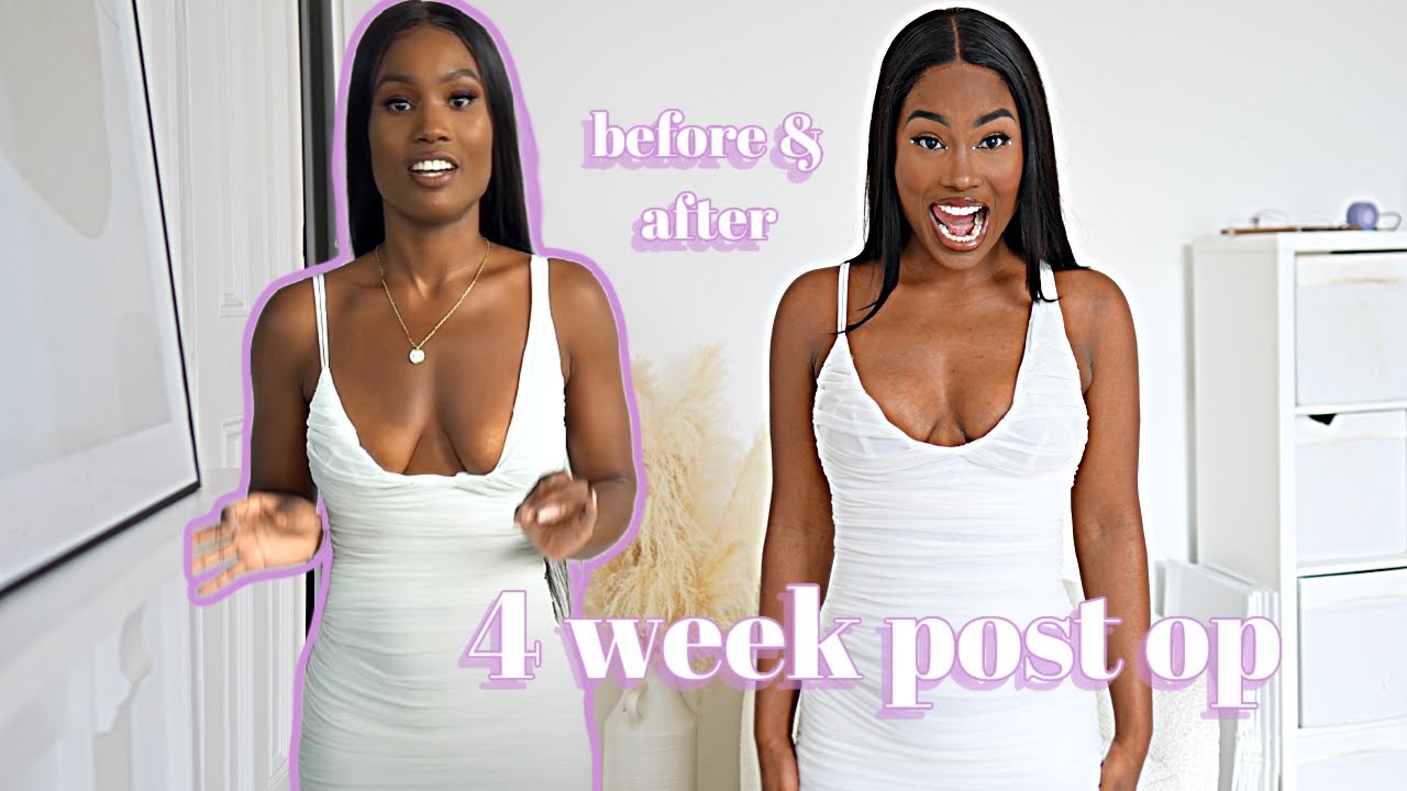 REVEALING MY NEW BODY 4 WEEK POST OP  😍 🍒- BEFORE & AFTER (My first impressions)