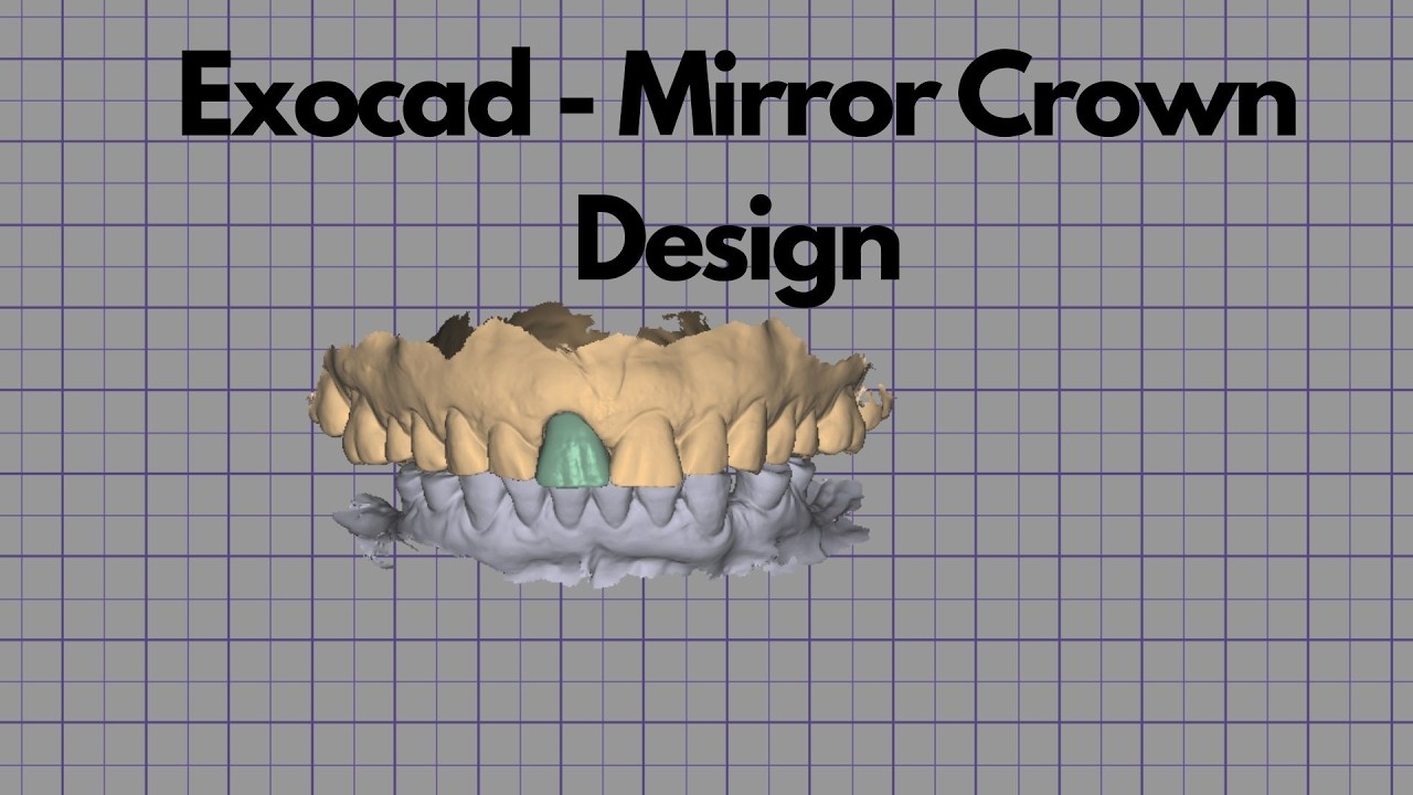Exocad - Mirror Crown Design