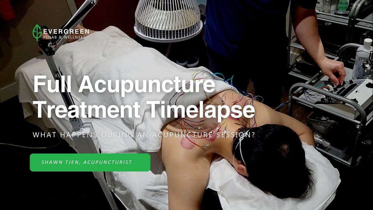 Full Acupuncture Treatment Timelapse at Evergreen Rehab and Wellness
