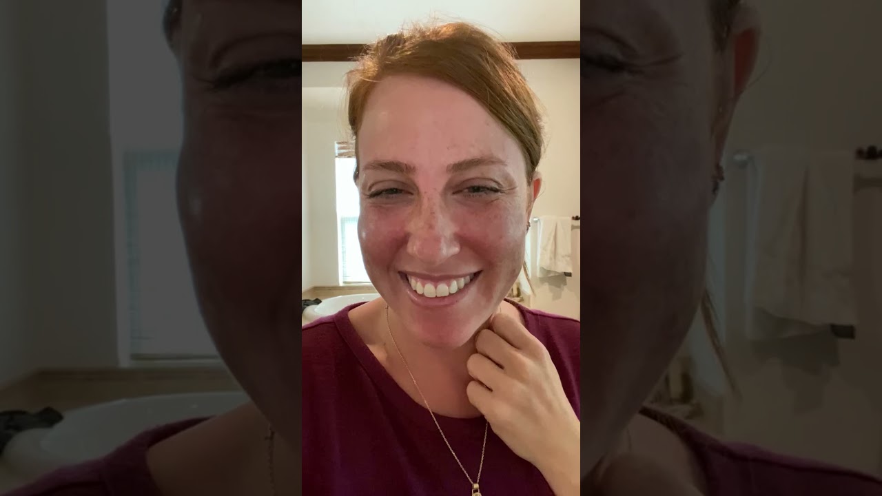 Fraxel Dual Treatment with Dr. Douglas Wu and Post Procedure Patient Video Diary