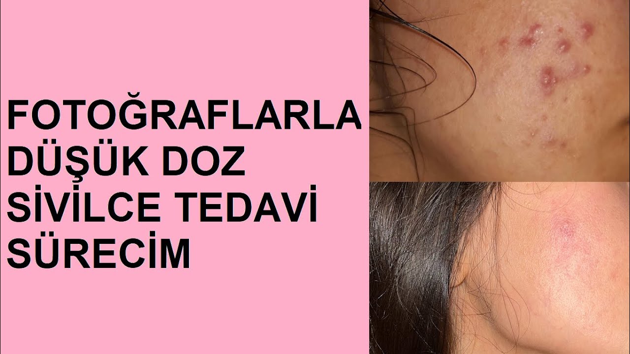 Düşük doz sivilce tedavisi ( izotretinoin Aknetrent ). Yalnızca 4 kutudan sonra yüzümün son hali !
