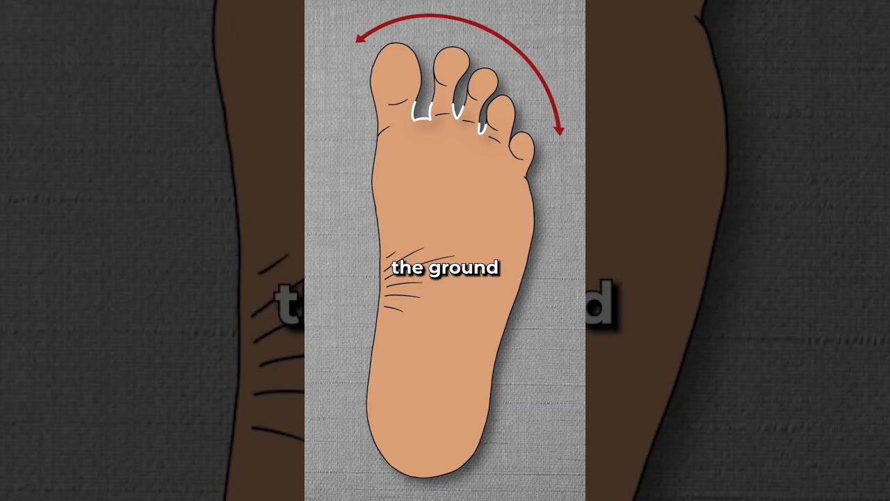How Bunions Actually Begin&hellip; #shorts