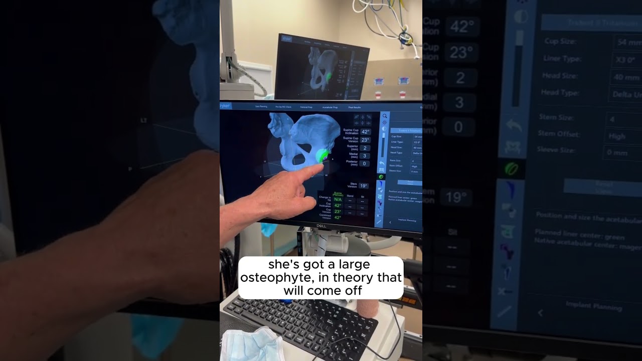 Hip Replacement Plan Using Robotic Assisted Surgery  