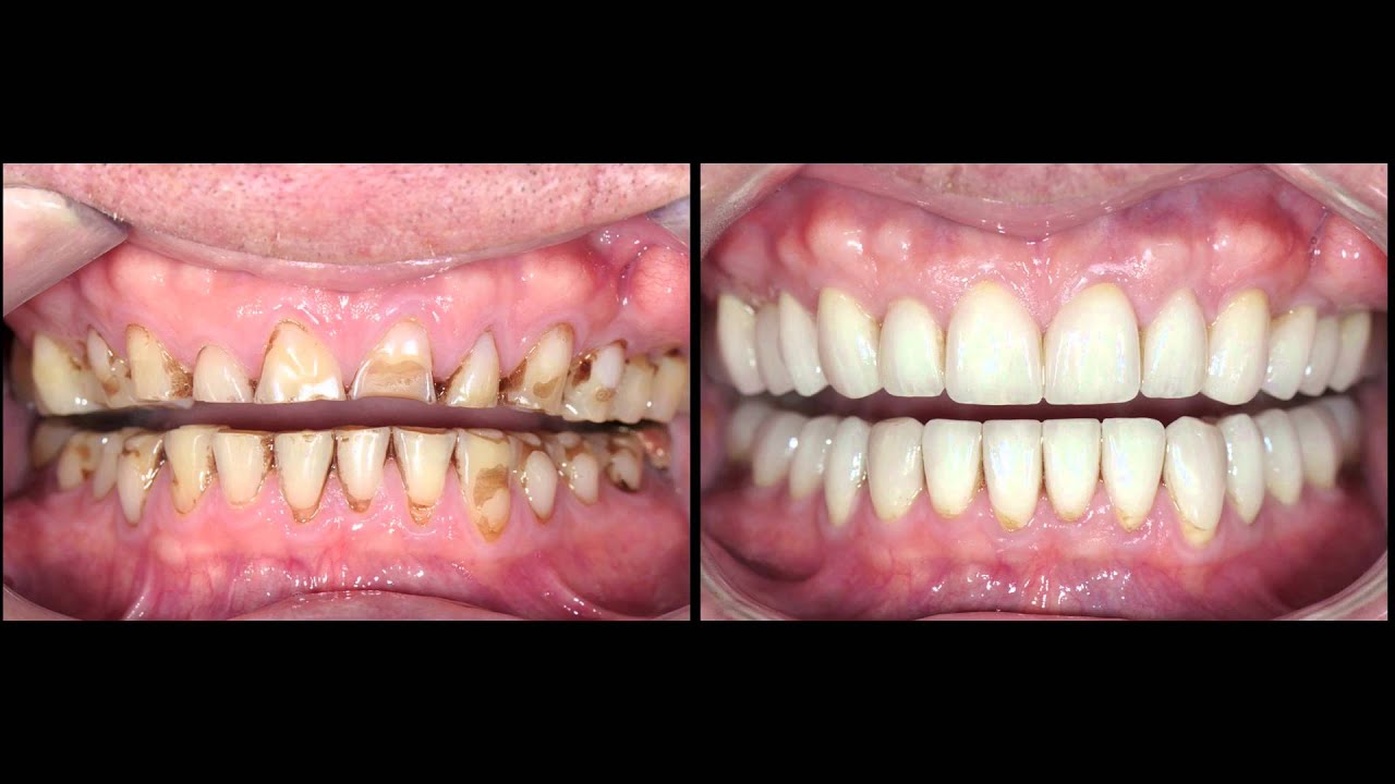 Full mouth rehabilitation for advanced tooth wear case study by Dr. Stephen Phelan
