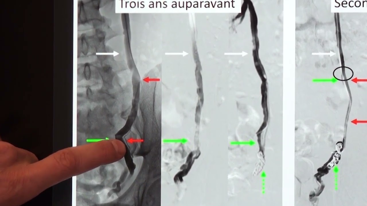 Varicocèle : un nouveau ressort