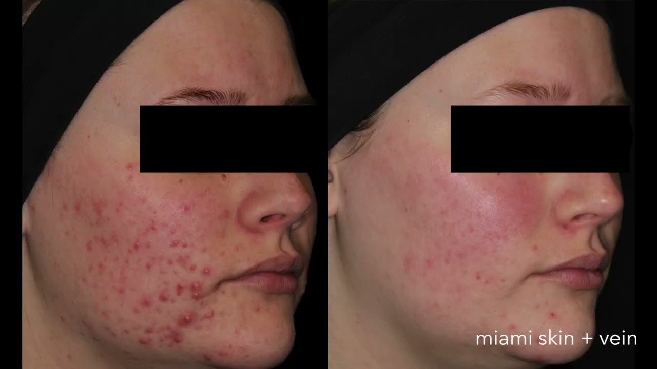 Aviclear - new laser treatment for acne that destroys sebaceous glands | Dr Shaun Patel | Miami, FL