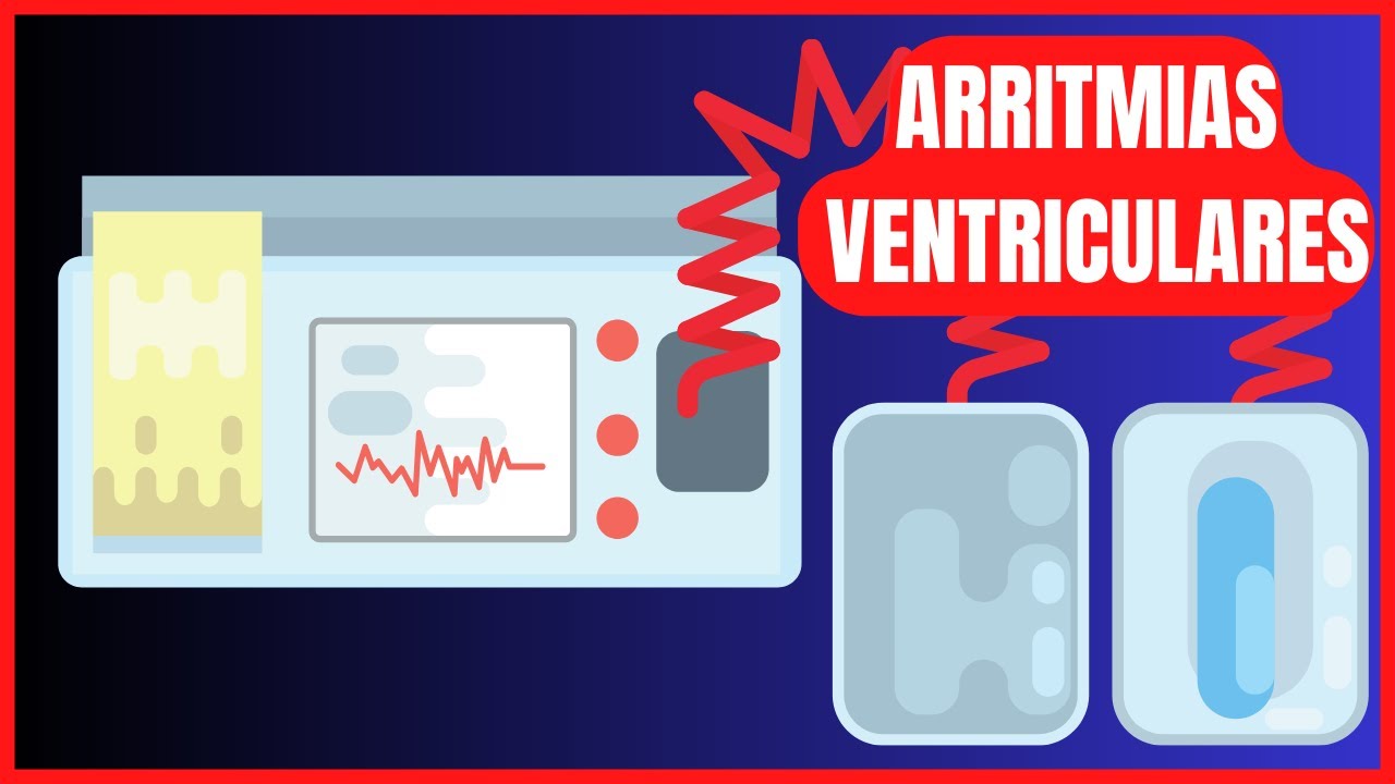 ARRITMIAS E  EXTRASSISTOLES VENTRICULARES SEMPRE S&Atilde;O GRAVES?