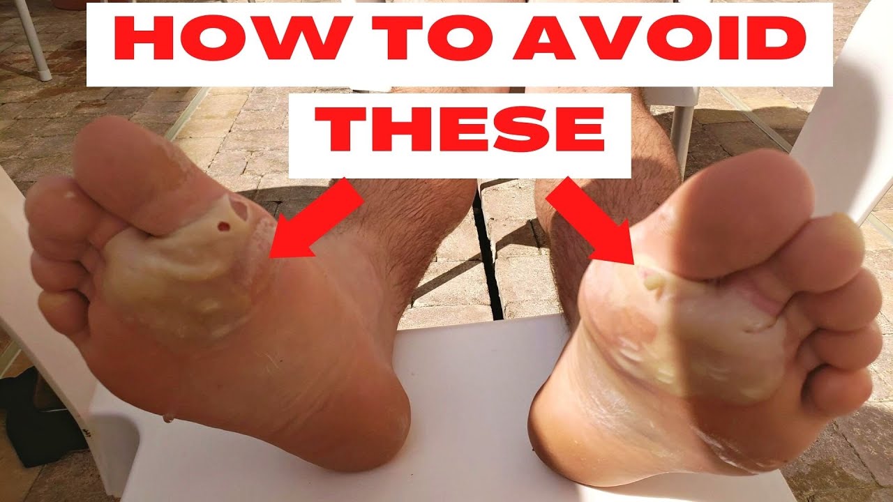 How to Prevent Blisters on the Camino de Santiago | Pain Free Trekking