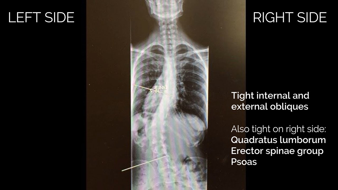 How Muscles Contract in Scoliosis C Curve