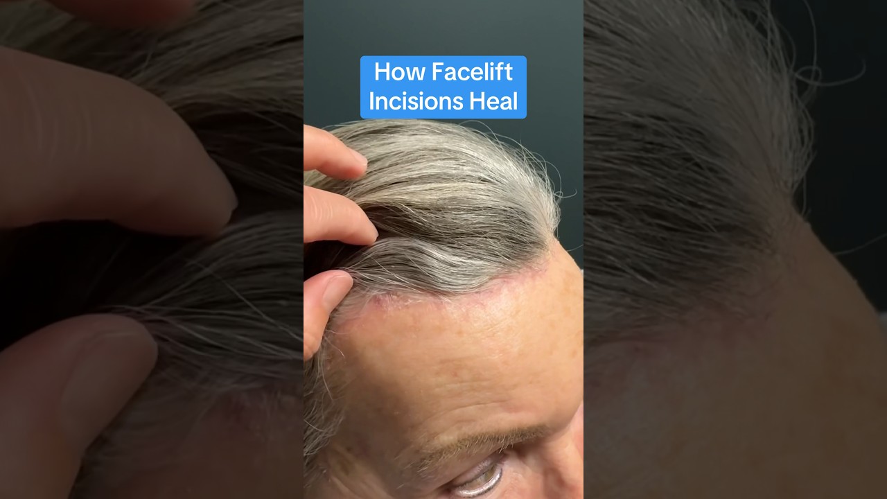 How Facelift Incisions Heal (Surgeon Reacts) #facelift