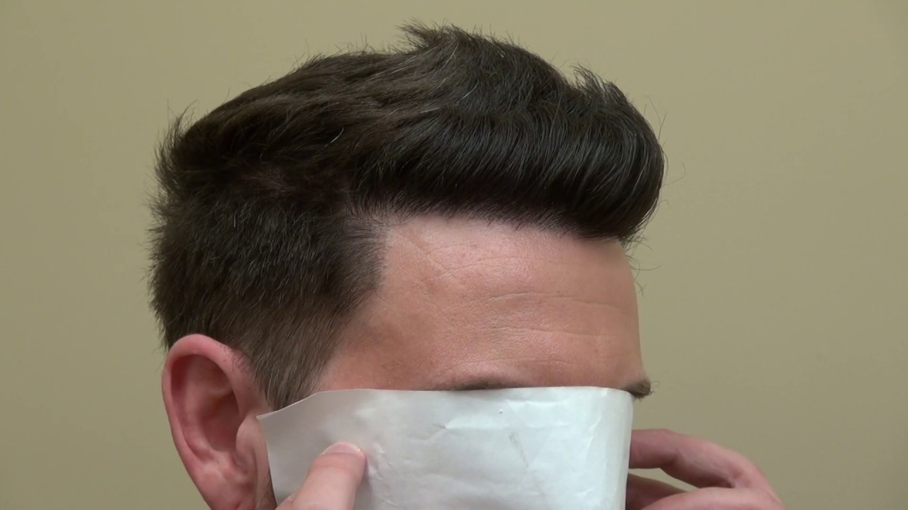 Perfect Hairline Restoration Lowering Surgery On Bald Advance Hair Loss by Dr. Diep