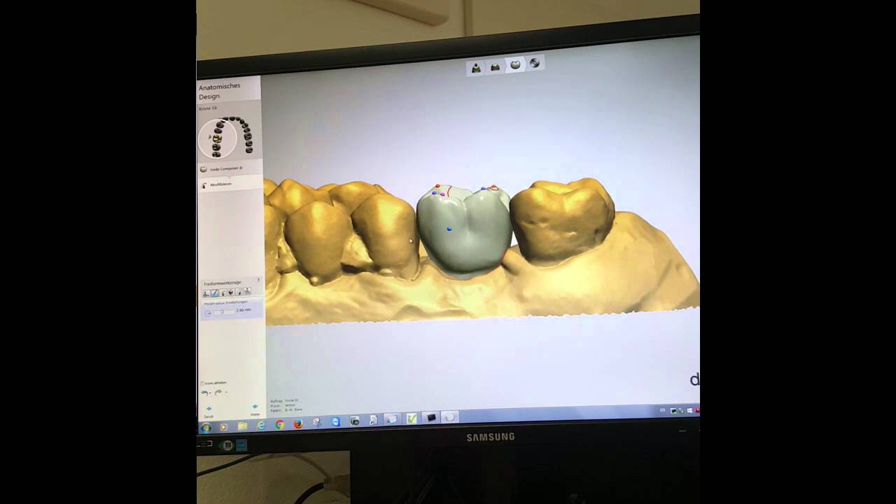 Implantat getragene monolithische Zirkonkrone auf Hybridabutment..