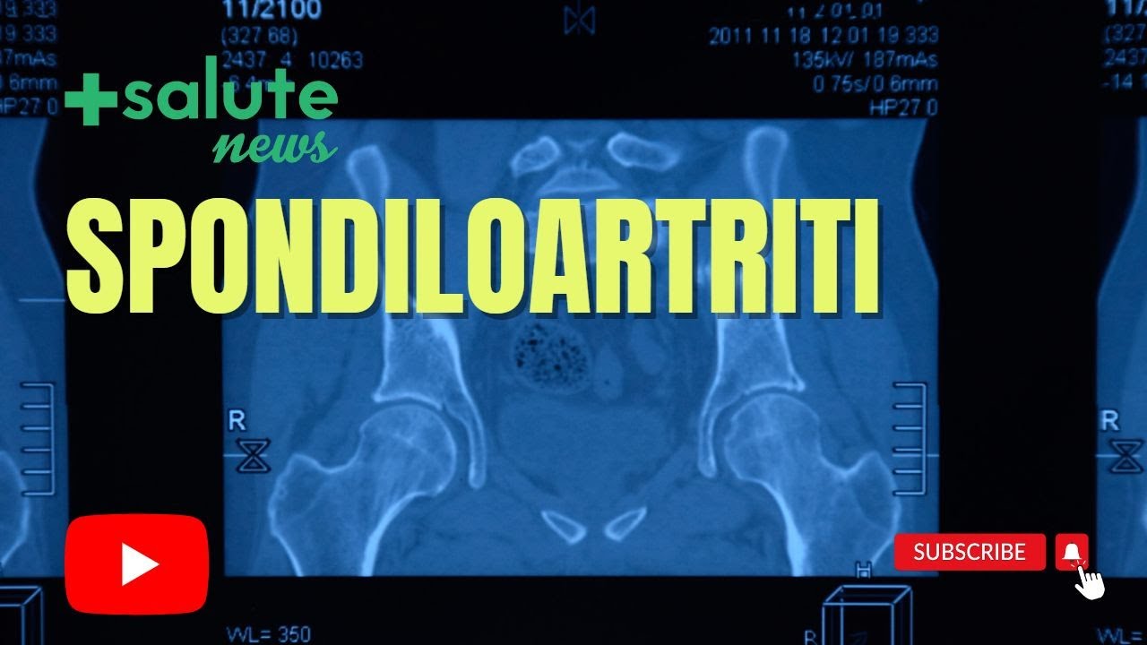 Spondiloartriti: confronto tra regioni Emilia-Romagna (Prof. Govoni) e Veneto (Prof. Doria).