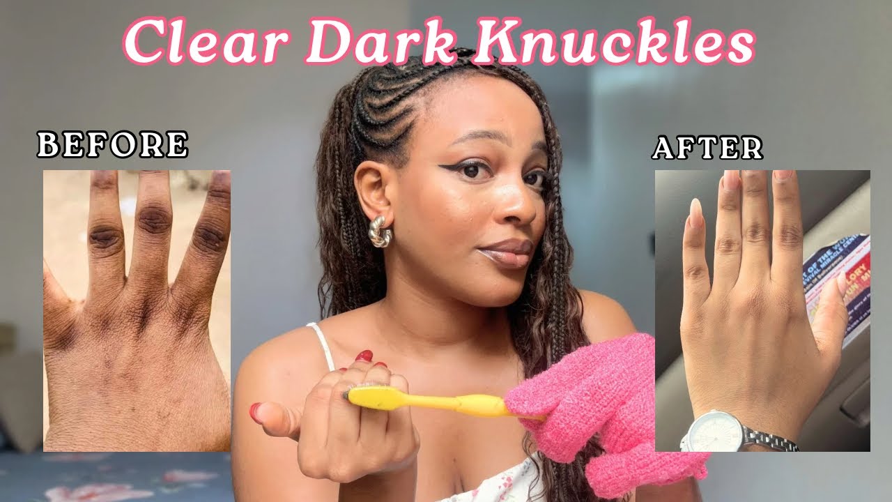 HOW I GOT RID OF MY DARK KNUCKLES IN TWO WEEKS | PERMANENT RESULT + NO PEELING