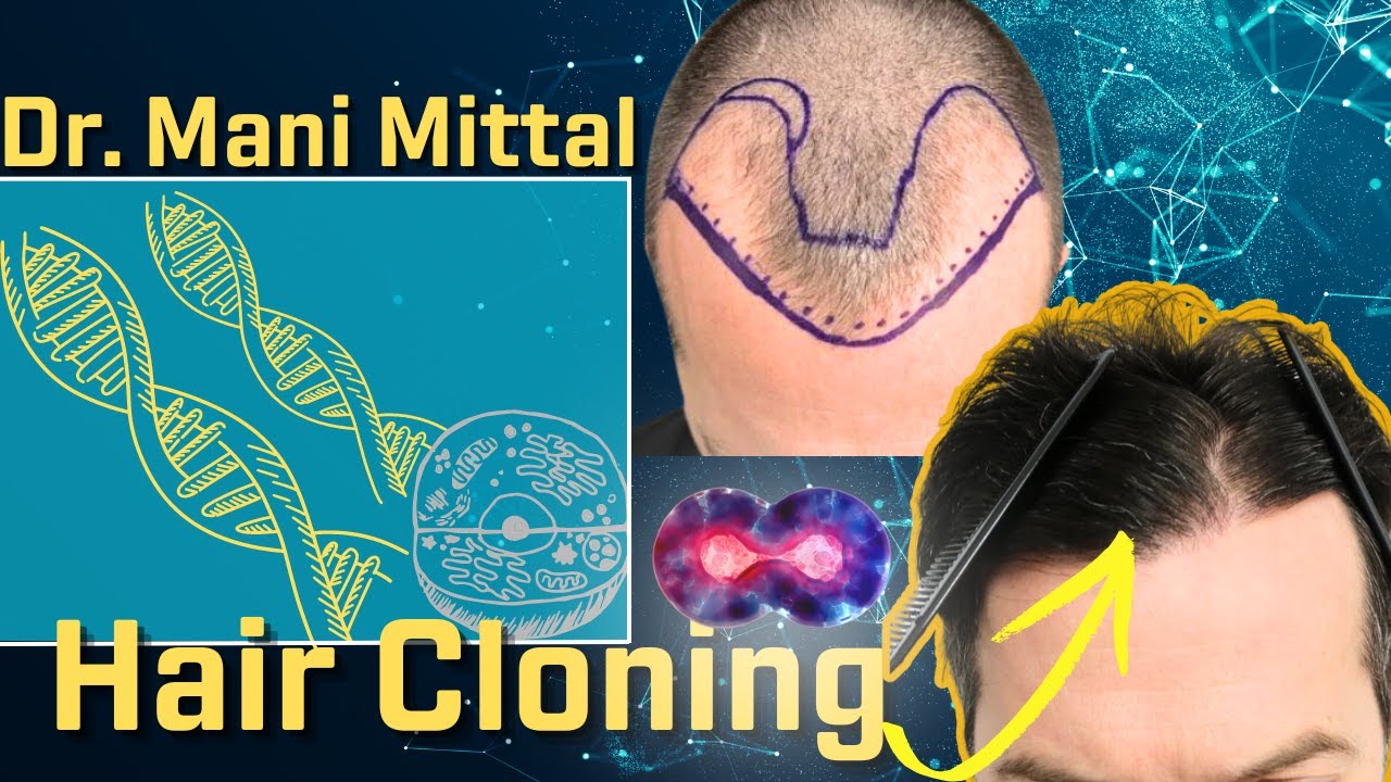Dr. Mani Mittal- Hair Cloning, Verteporfin, Stem Cells, Hair Transplant Artistry