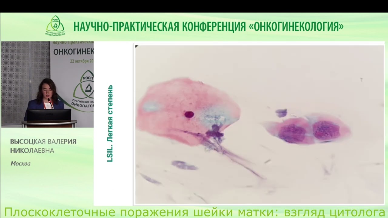 Плоскоклеточные поражения шейки матки: взгляд цитолога