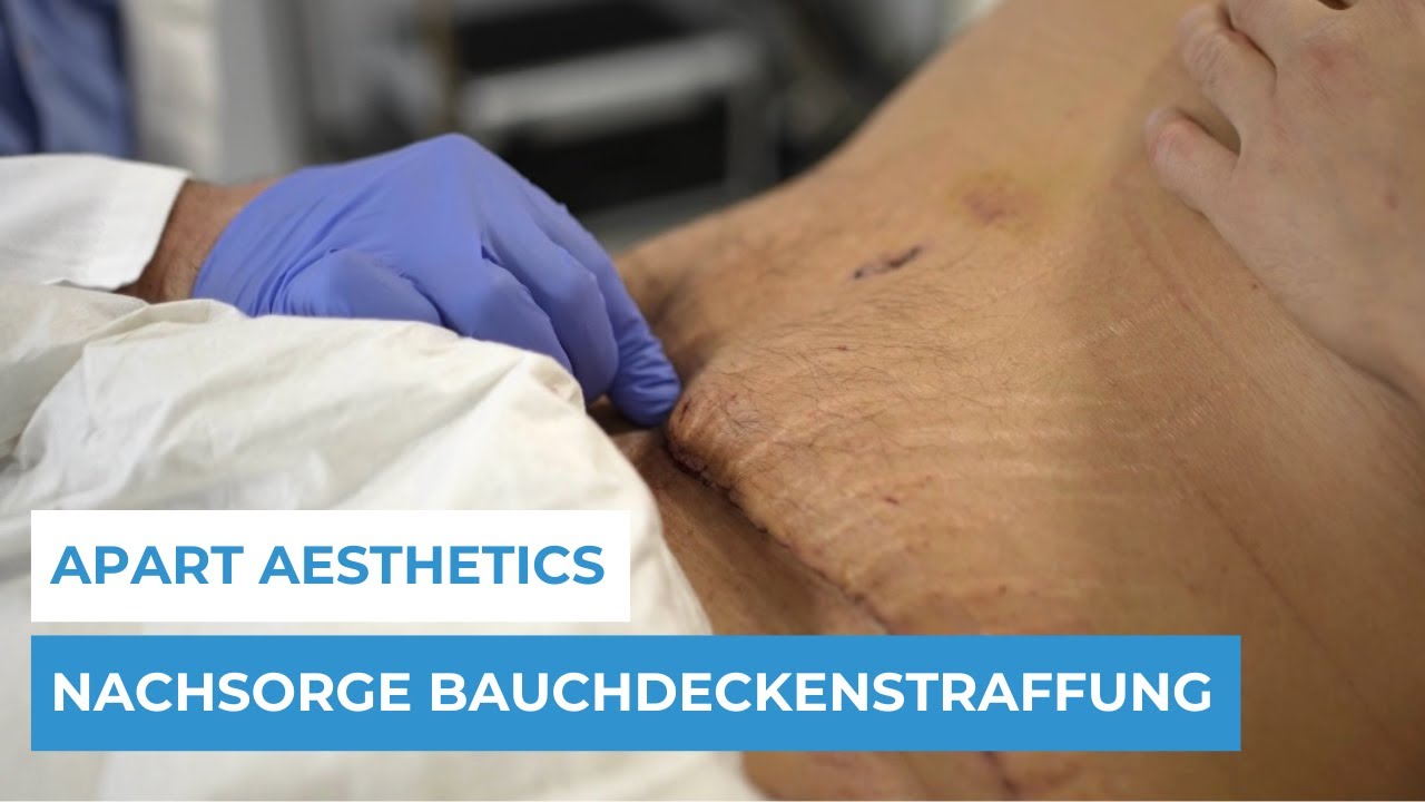 APART AESTHETICS - NACHSORGE: Bauchdeckenstraffung