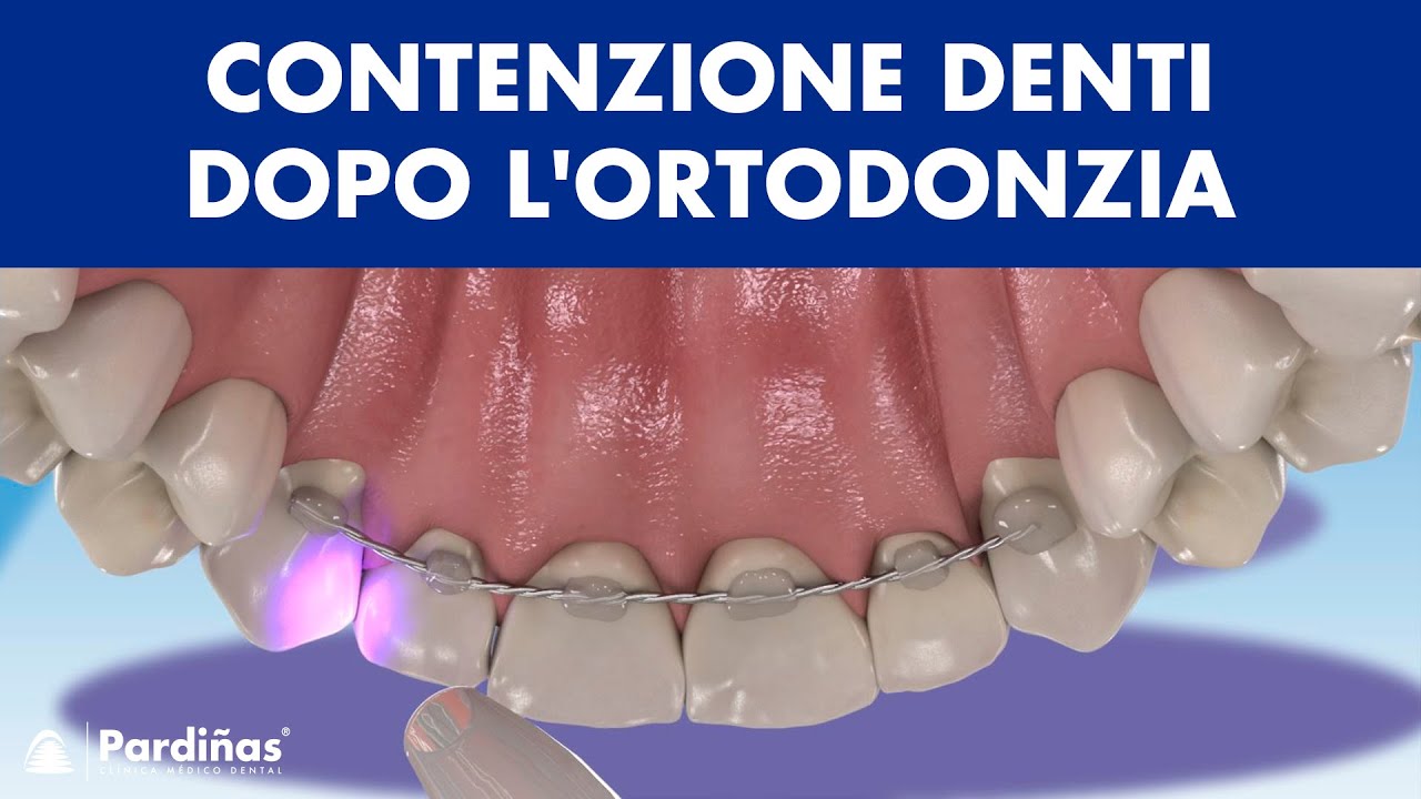 CONTENZIONE DENTI - Come prevenire lo spostamento dei denti dopo l'ortodonzia ©