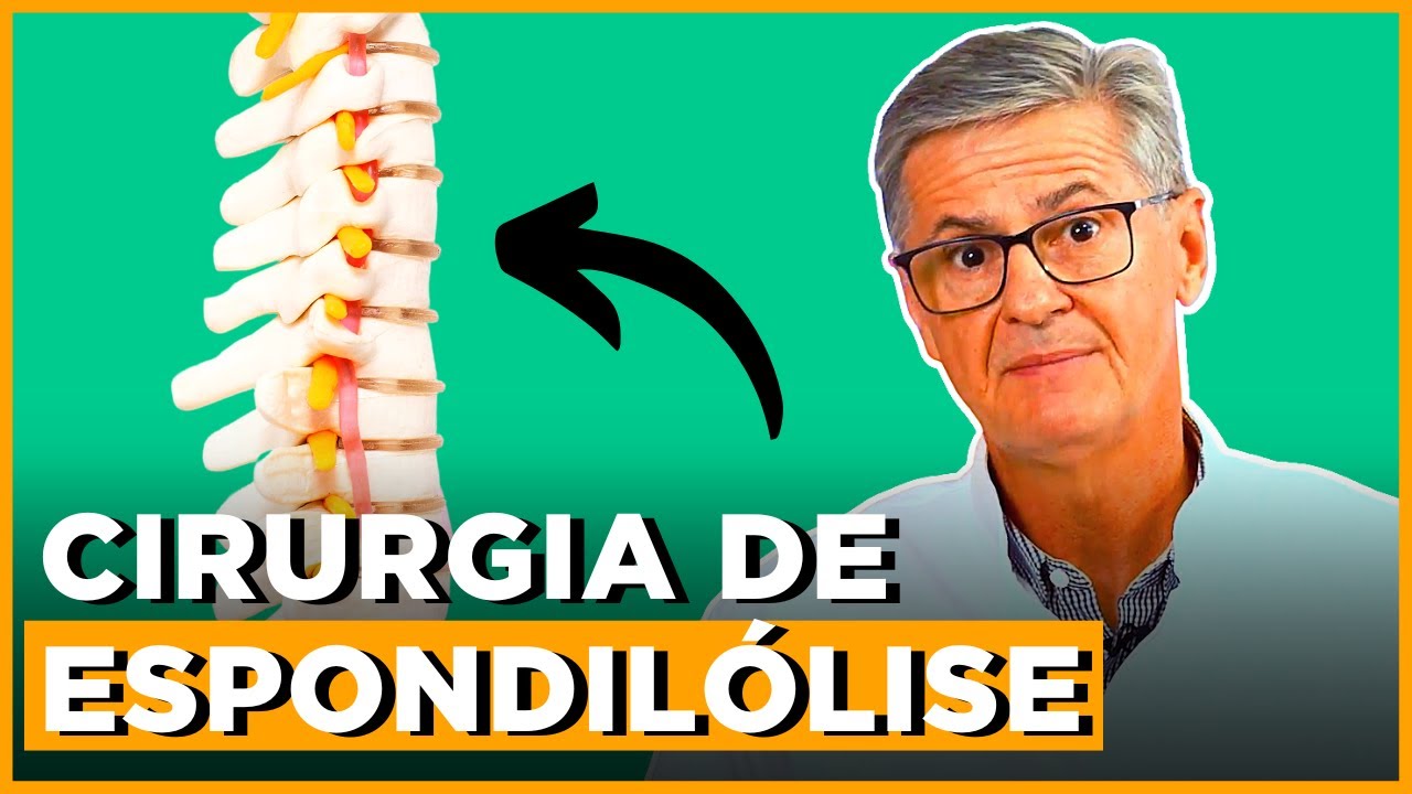 Como é a Cirurgia de Espondilólise - Explicação Completa | Simplificando Ortopedia