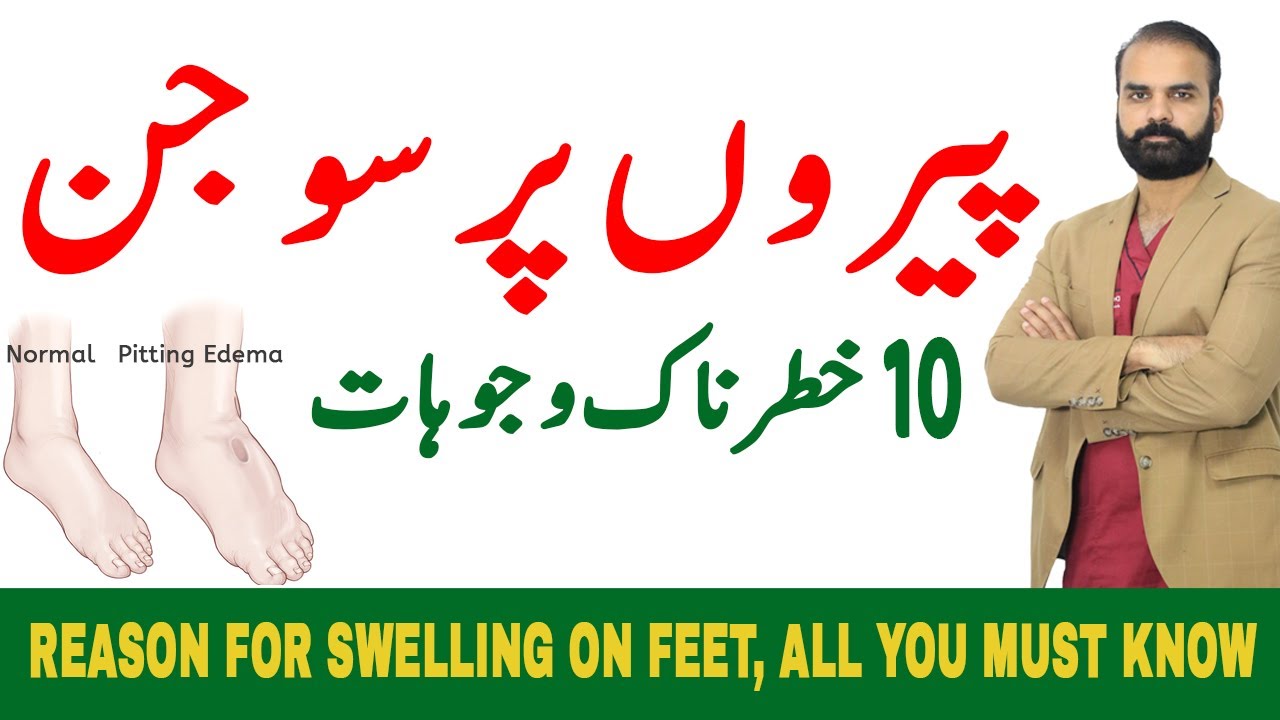 10 Dangerous Reasons for Swelling on Feet - What causes swollen legs and feet?【Edema in Hindi/Urdu】