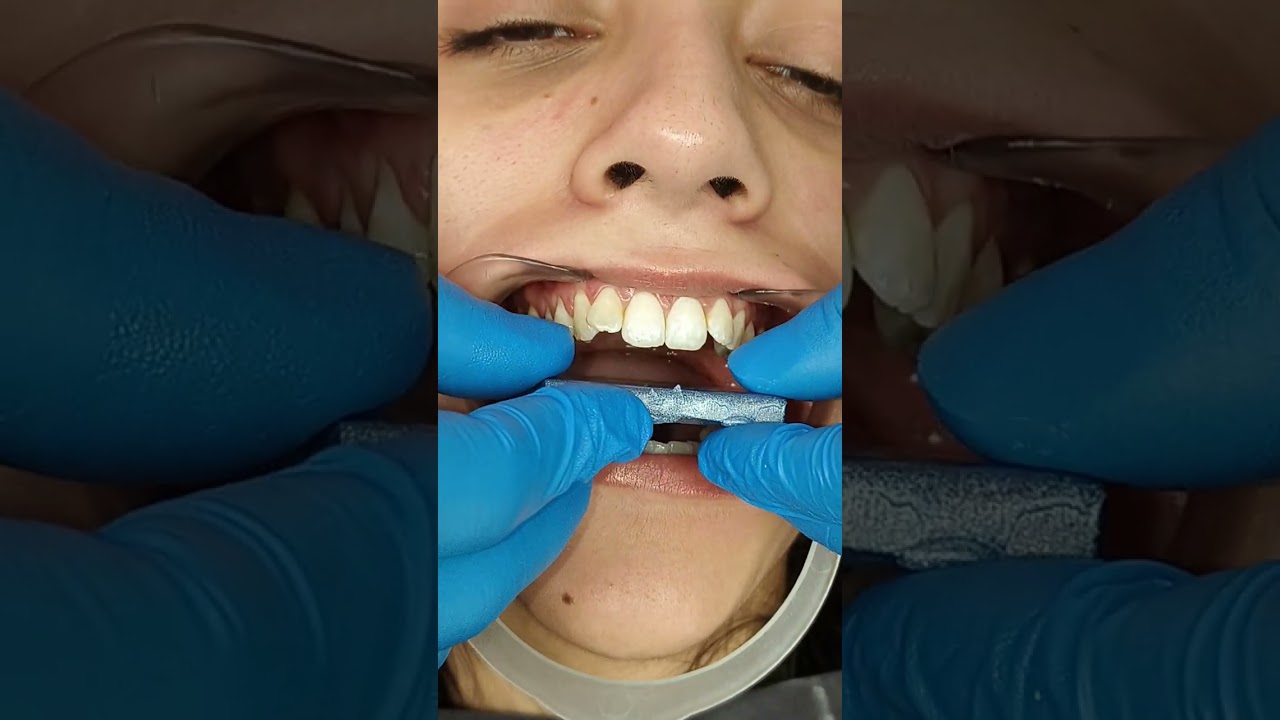 HOW TO RECORD PROTRUSIVE BITE FOR ANTERIOR REPOSITIONING SPLINT