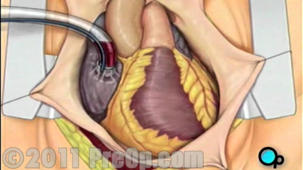 Coronary Artery Bypass Graft (CABG) Surgery PreOp&reg; Patient Education