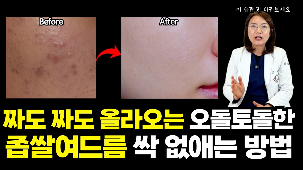 자꾸 올라오는 좁쌀 여드름, 이 영상으로 해결하세요