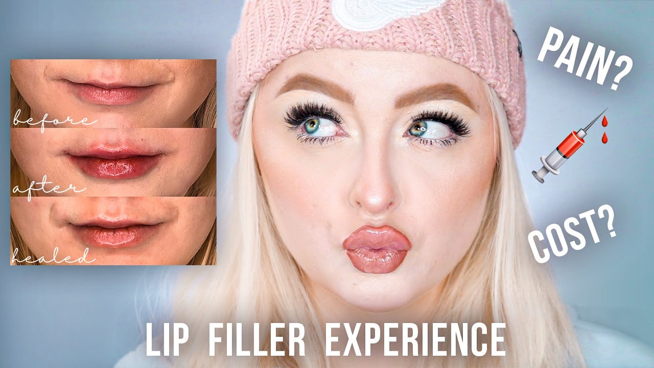 FIRST TIME GETTING LIP FILLER | Healing, Experience, Price, Pain, etc. | MCDREW
