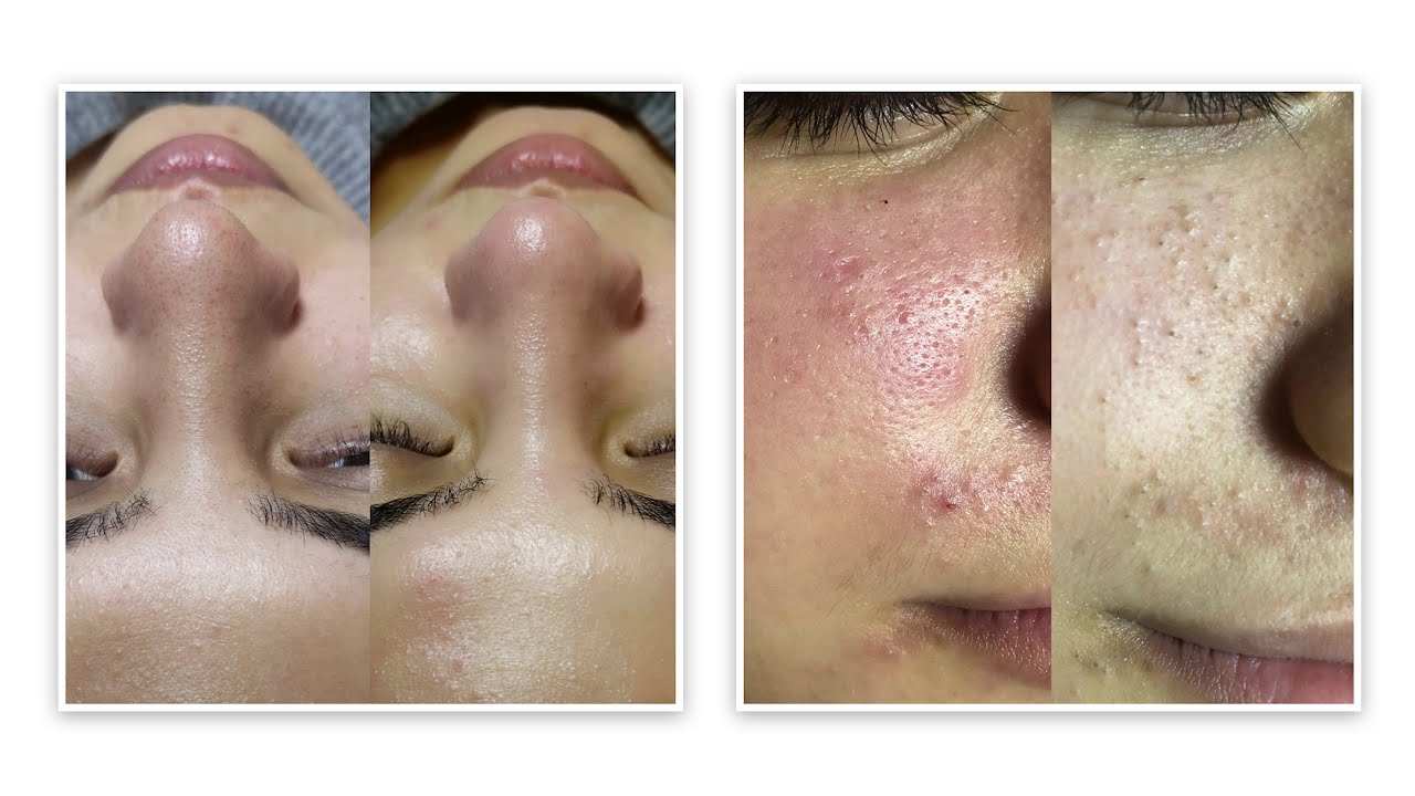 Hydrafacial Cilt Bakımı Uygulaması Öncesi ve Sonrası I Pervin Dinçer