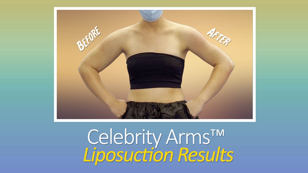 Arm Liposuction | Lipo 360&deg; Celebrity Arms&trade; Liposuction | Immediate Results | Expert Dr. Thomas Su