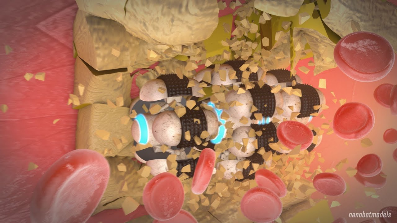 Nanorobot for atherosclerosis plaques removing