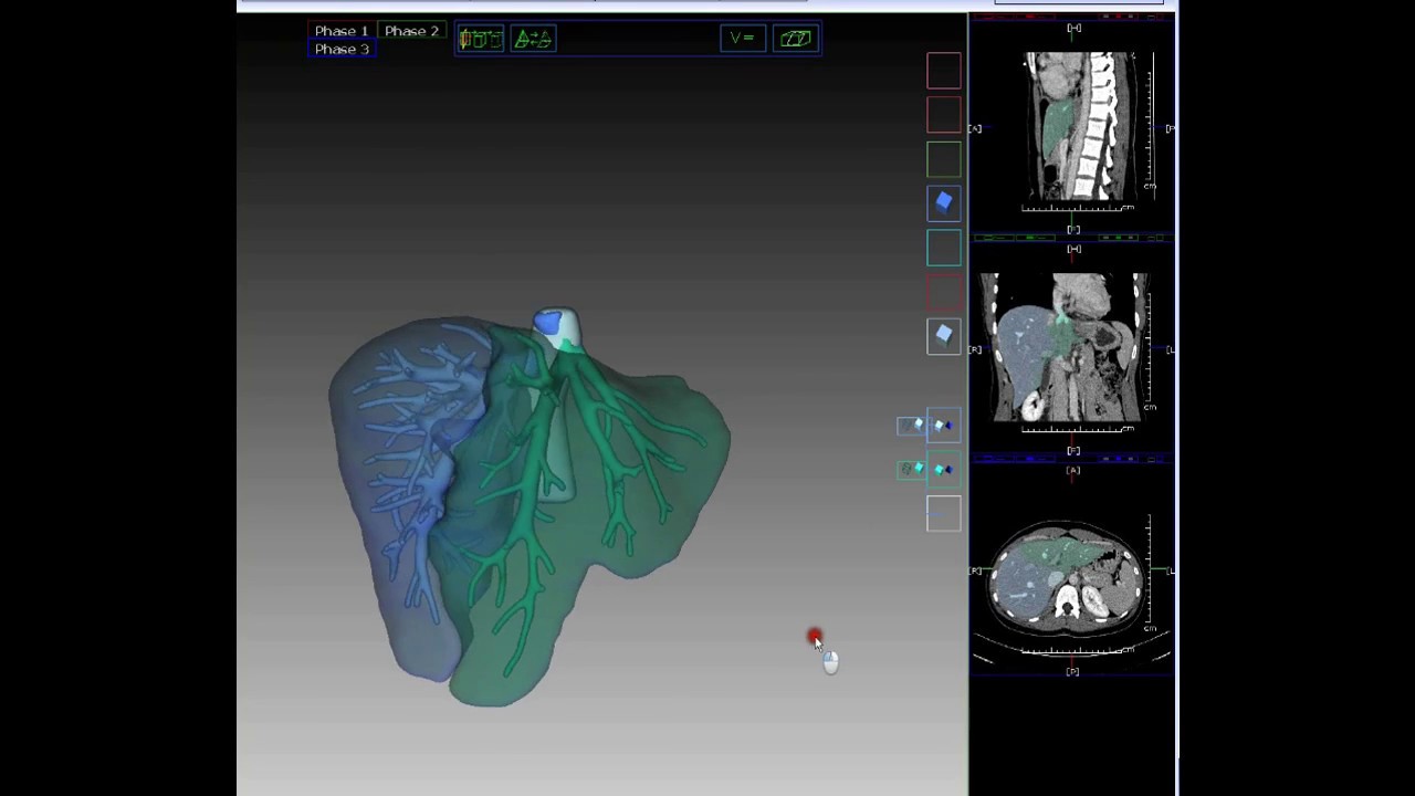IQQA&reg;-Liver for Virtual Liver Resection