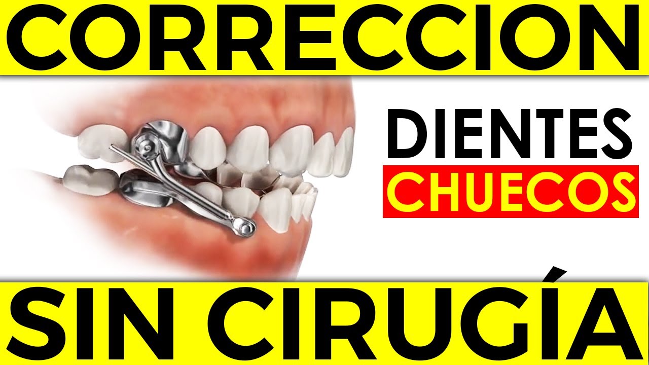 ¿Cómo ENDEREZAR mis Dientes CHUECOS sin Cirugía? Estos son los BENEFICIOS de la Ortopedia Funcional
