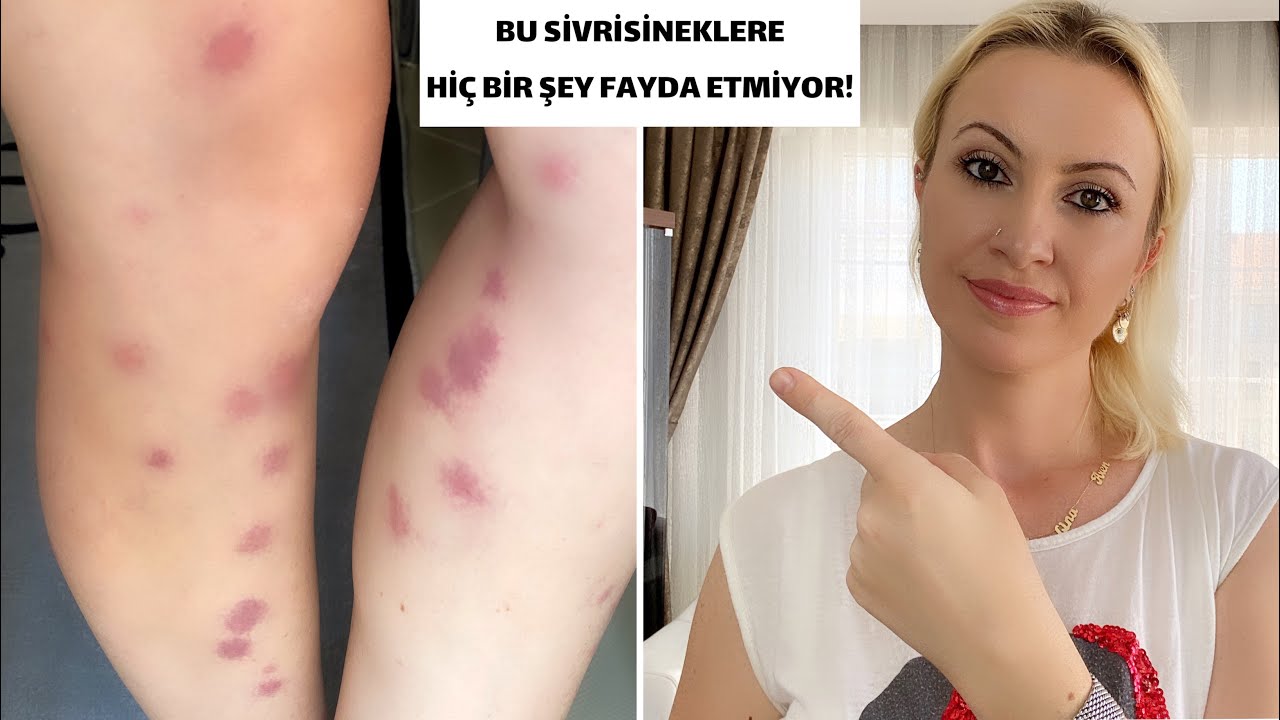 Sivrisinek Kabusu! Bir Gecede 54 Isırık😲 Sonrası İçin Ne Yapmalısınız?