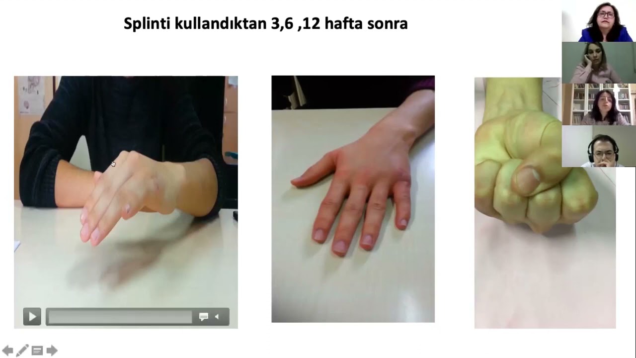 Ekstansör tendon tamiri sonrasında rehabilitasyon Prof Dr Çiğdem Öksüz