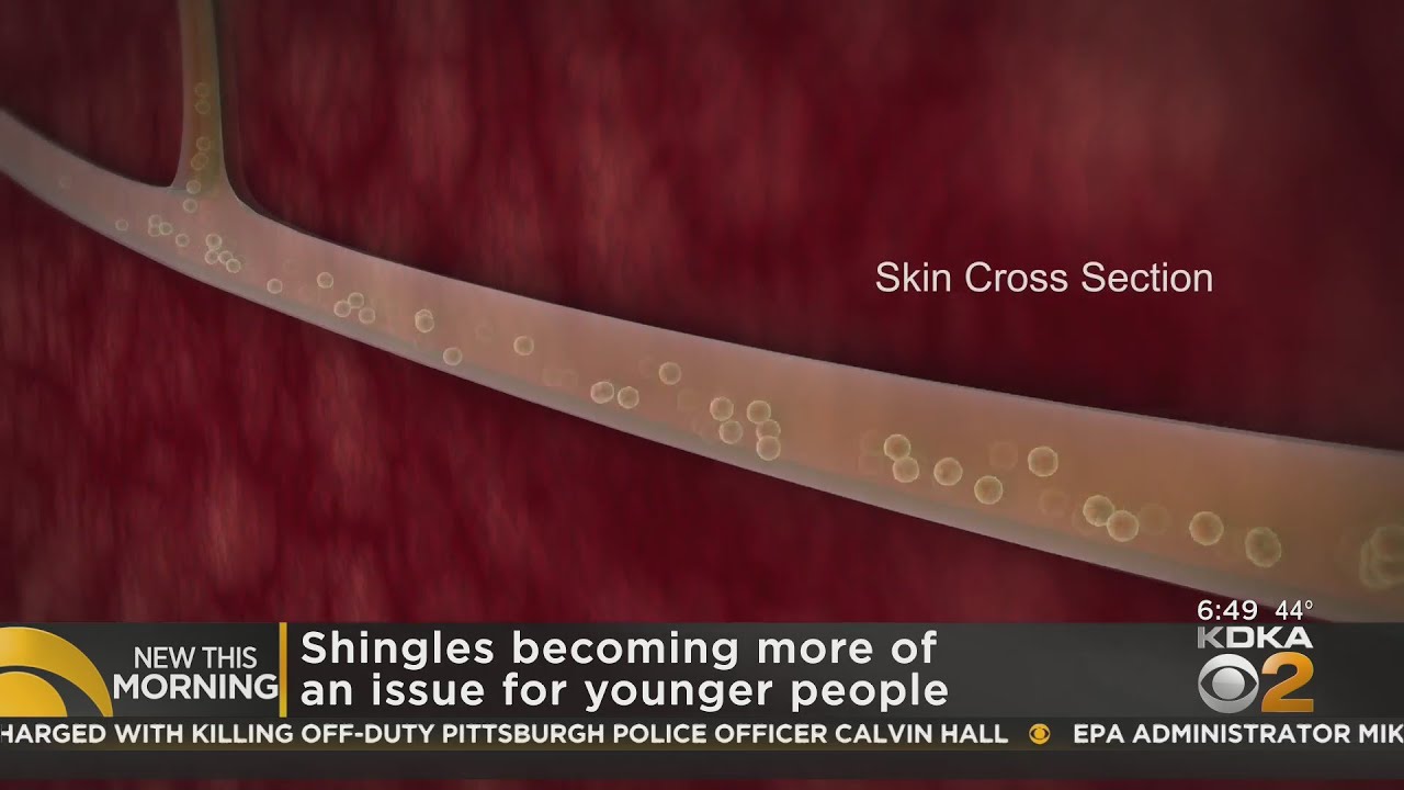 Shingles cases on the rise in younger patients