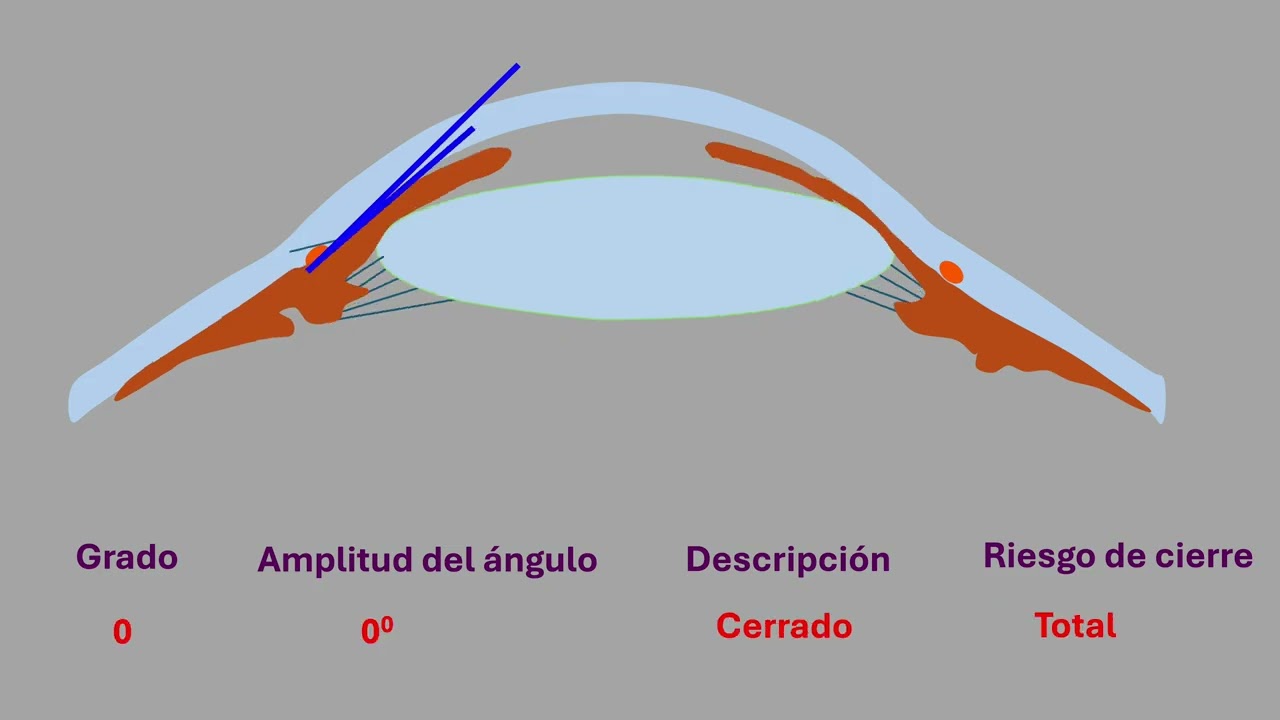 Glaucoma de ángulo abierto y cerrado