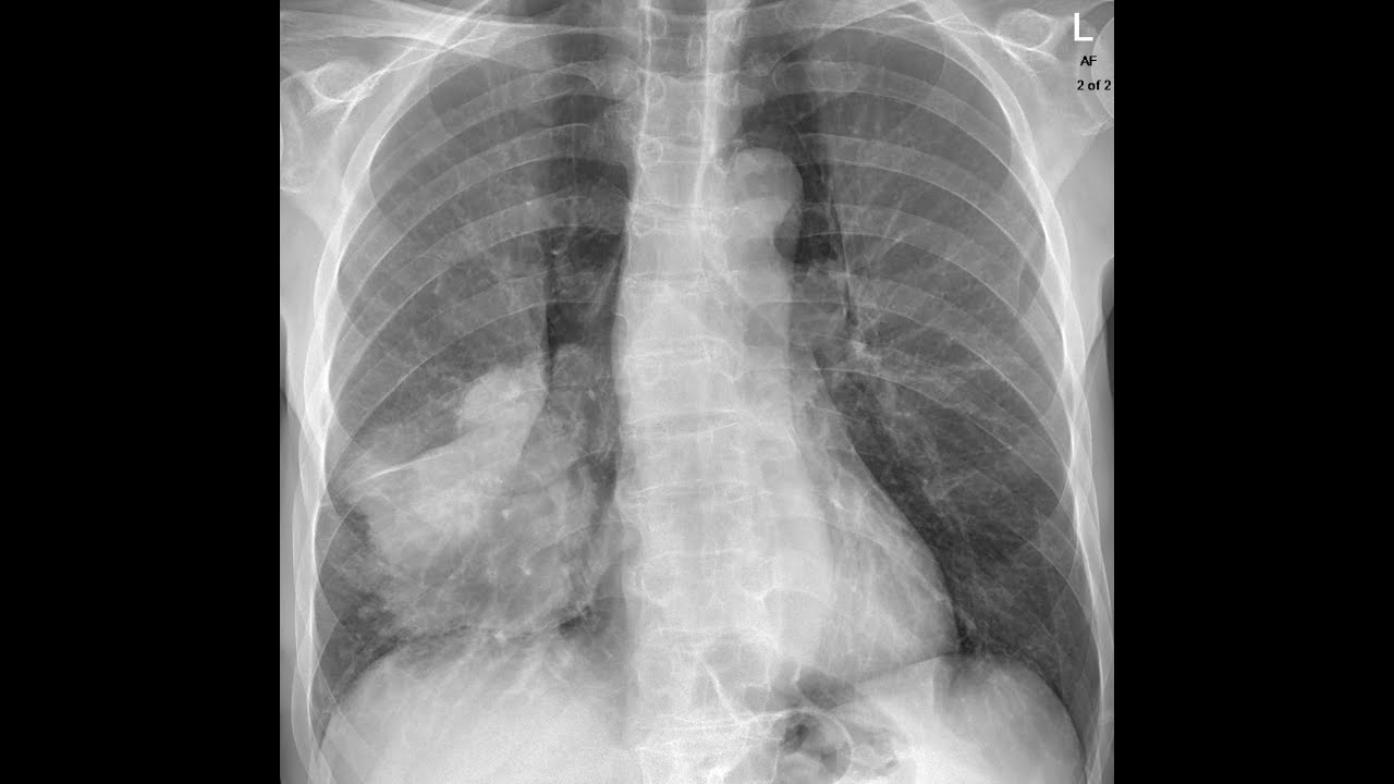 Вебинар по кардиоторакальной хирургии, 08.01.2026