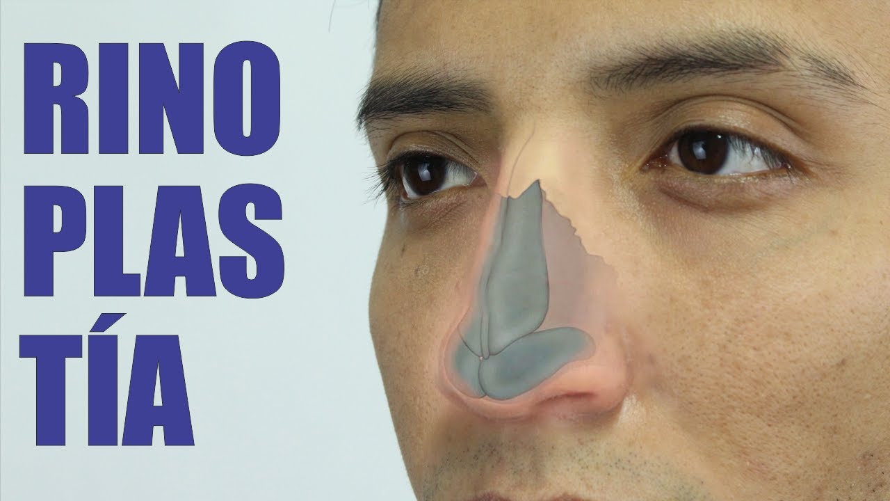 RINOSEPTOPLASTÍA: Nariz grande y desviada 👃🏼 RINOPLASTÍA estética y funcional ❤️ Dr PERCY NEVADO