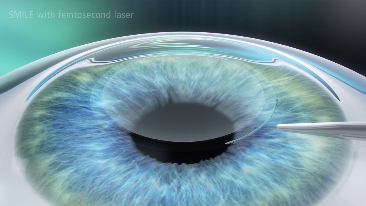SMILE(Small Incision Lenticule Extraction)