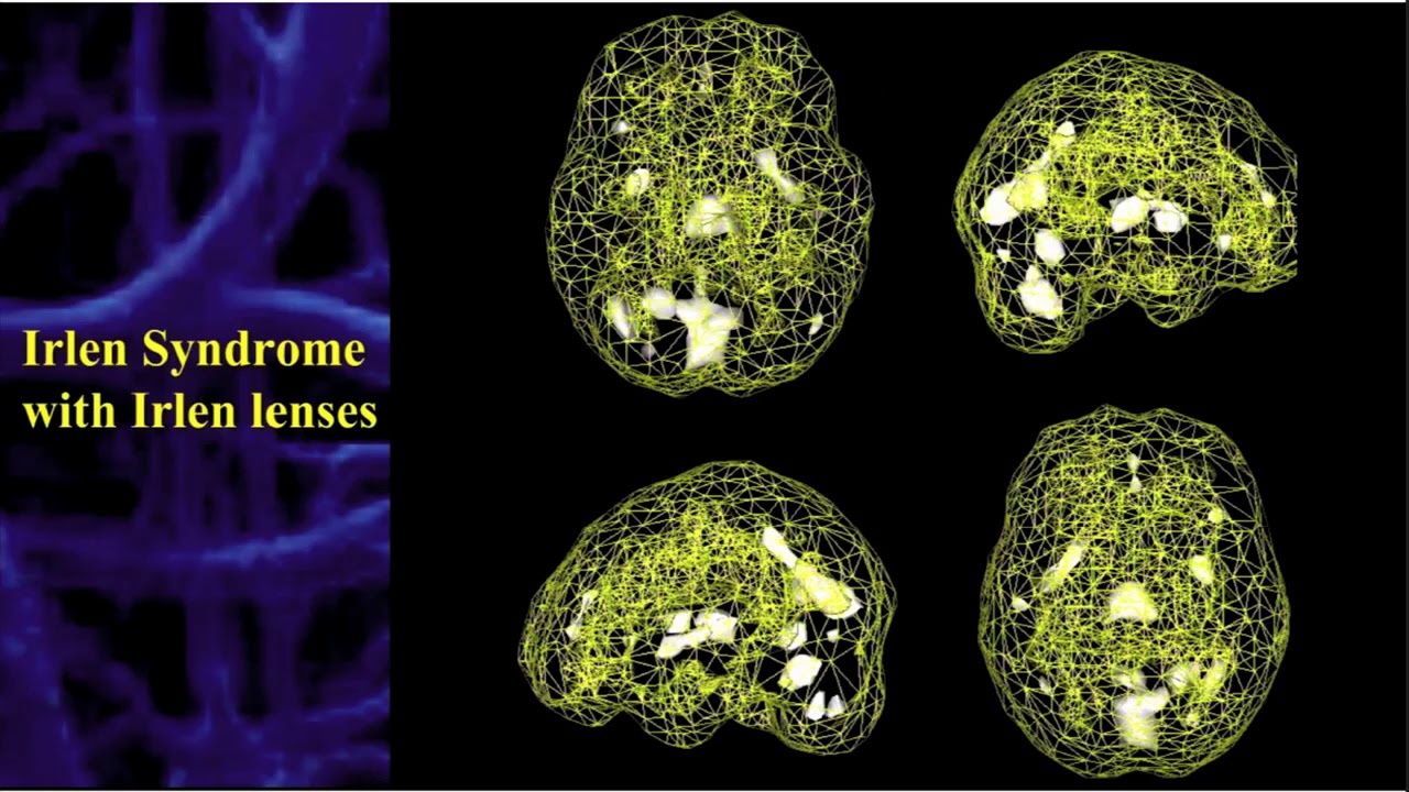 07. Visual Distortions and Irlen Syndrome Scotopic Sensitivity
