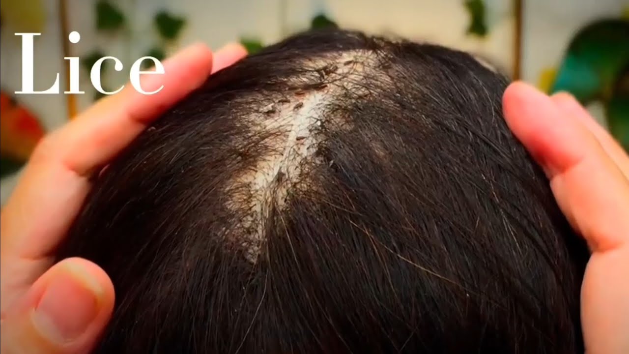ASMR 💜 Whispering and Lice Removal 💜 You Will feel sleepy 😴💤💤