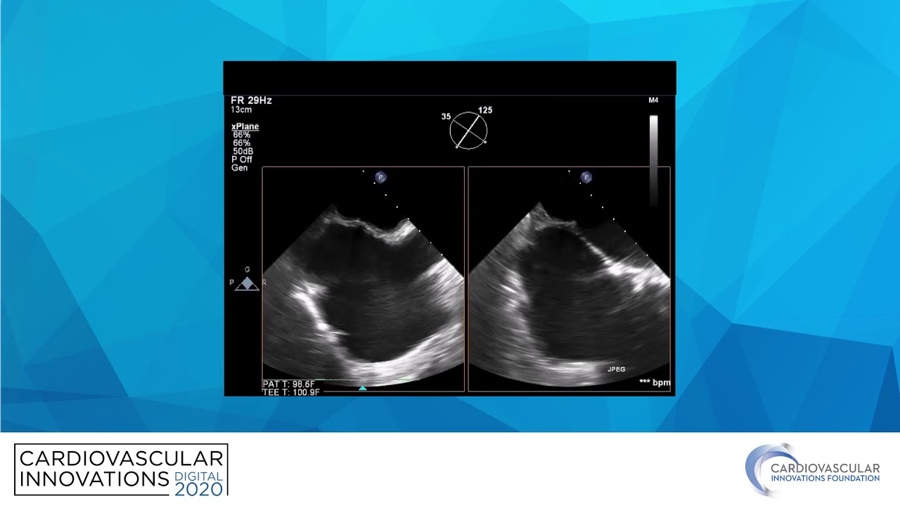 How I saved my proceduralist with imaging-Said Alsidawi, MD